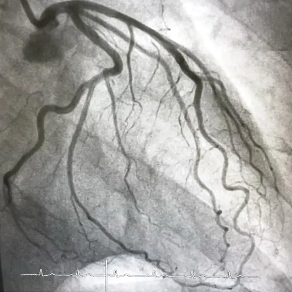 CORONARY ARTERY DISEASE