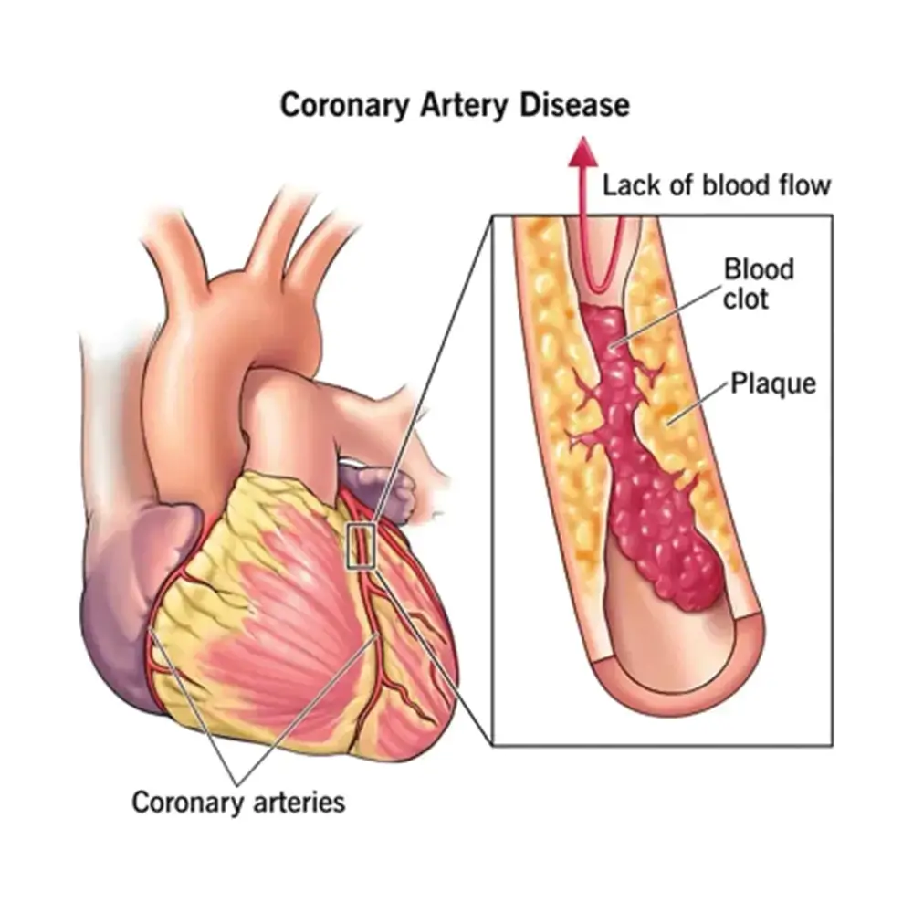 CORONARY ARTERY DISEASE