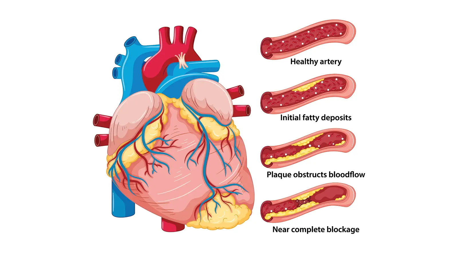 CORONARY-ARTERY-DISEASE-1