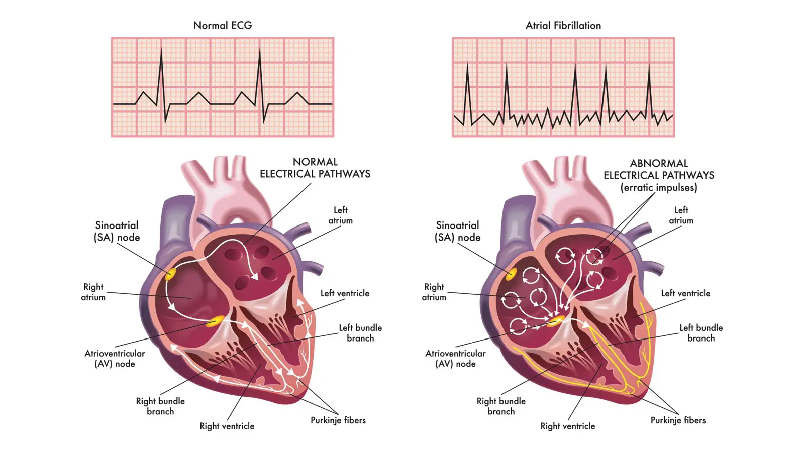 Atrial Fibrillation 1 1