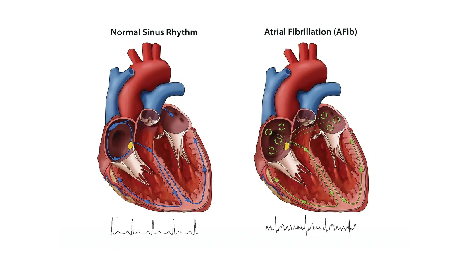 Atrial Fibrillation 2 Atrial Fibrillation 1