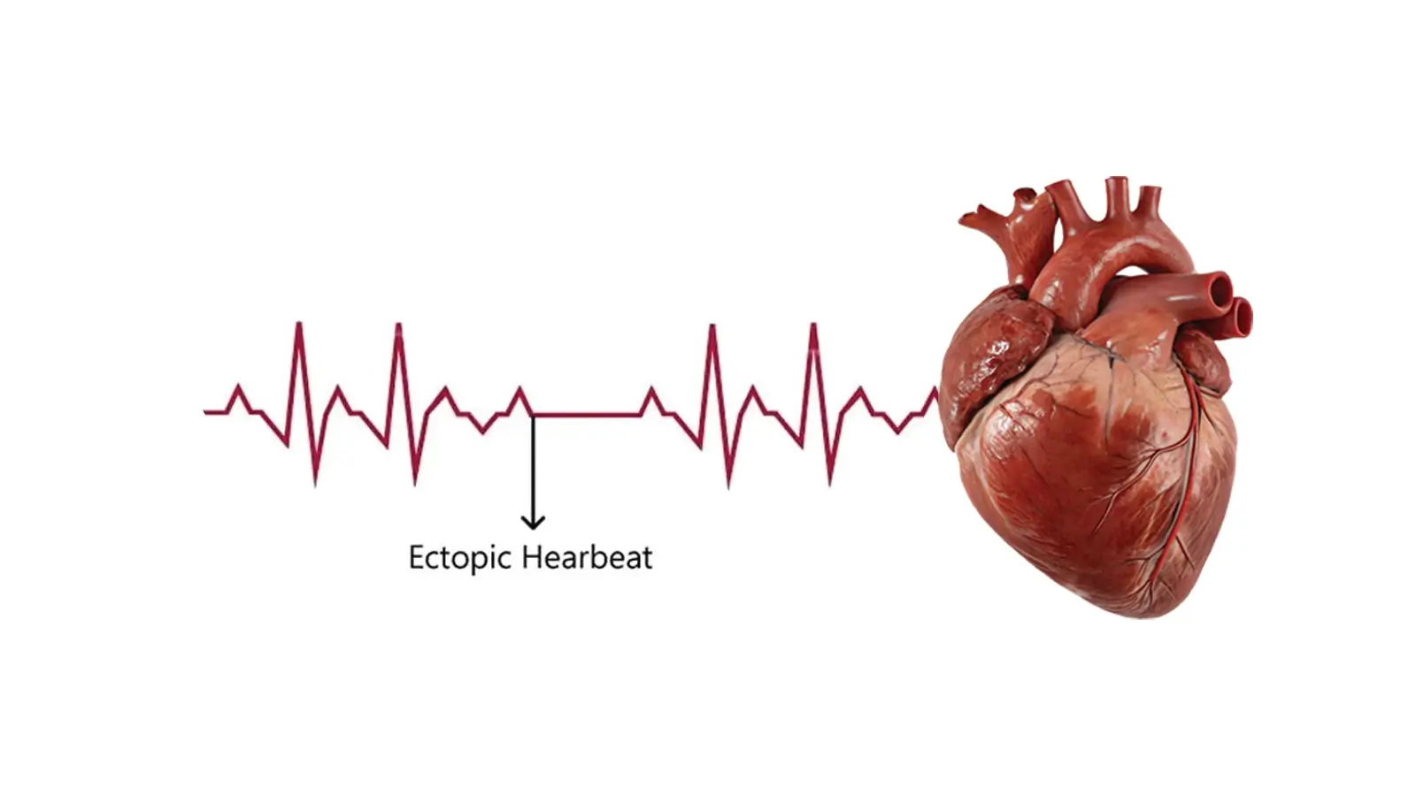 Ectopic Heartbeat 