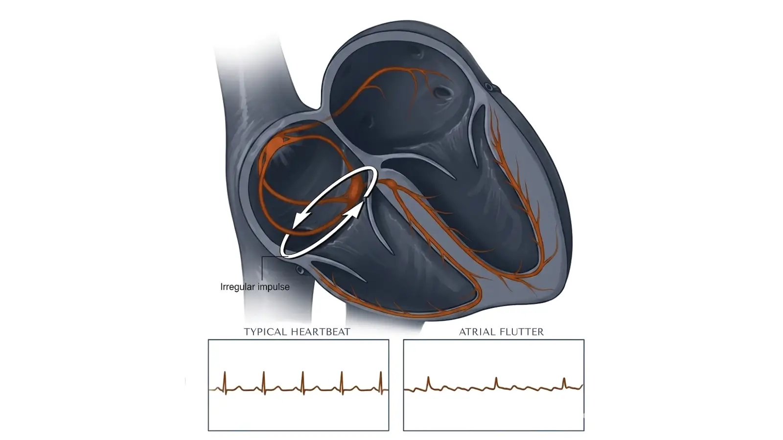 Atrial Flutter