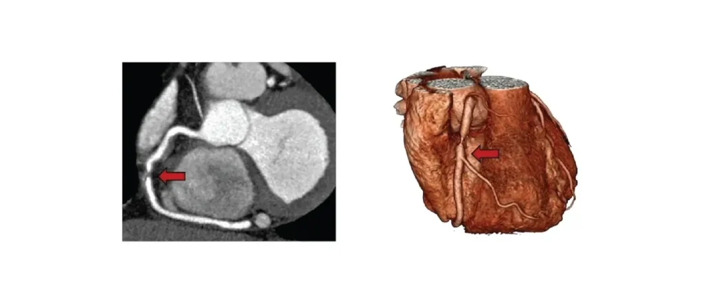 Cardiac CT Scan Vs CT Angiogram: What is the Difference? 3 CT Angiogram