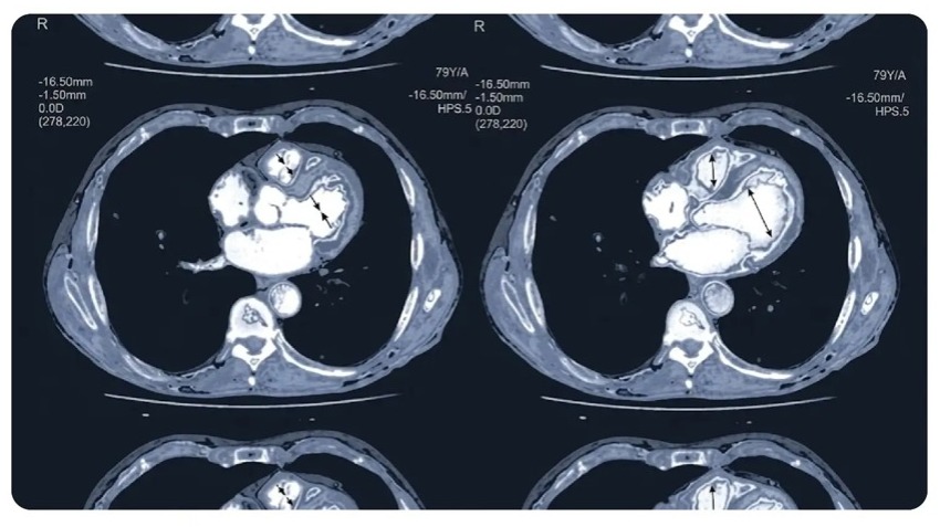 Cardiac CT Scan Vs CT Angiogram: What is the Difference? 2 CT Scan