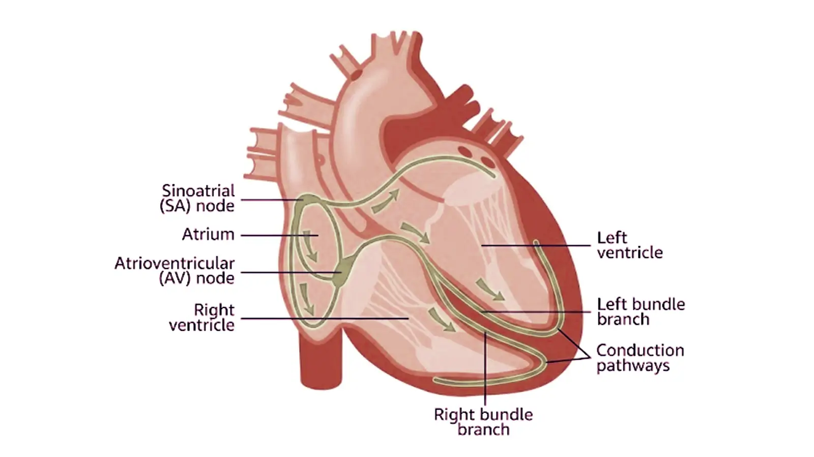 Supraventricular tachycardia