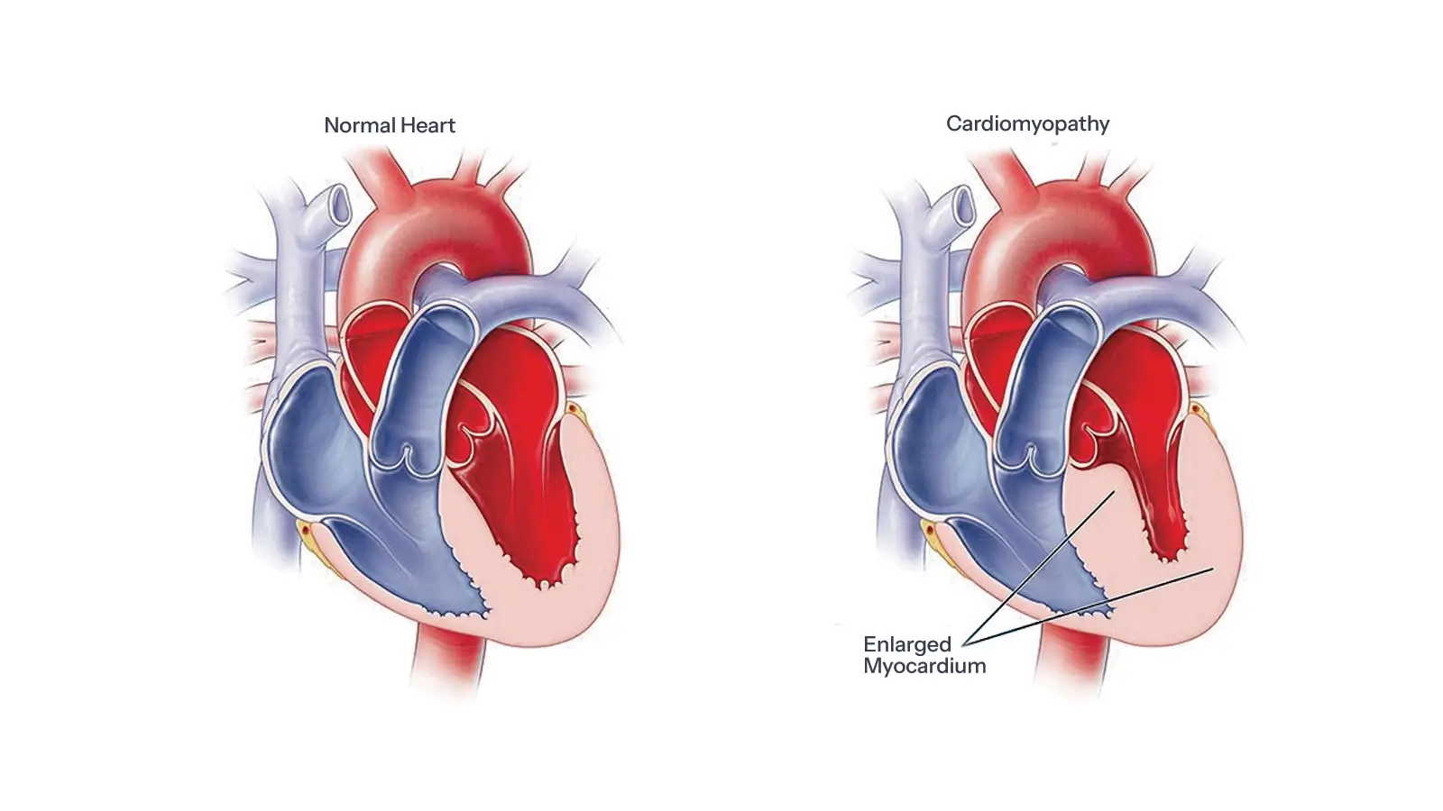 Cardiomyopathy 1 Cardiomyopathy